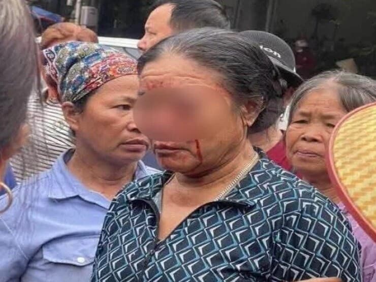 Sức khoẻ người bán rau bị chủ quán hải sản xịt nước chảy máu mắt bây giờ ra sao?